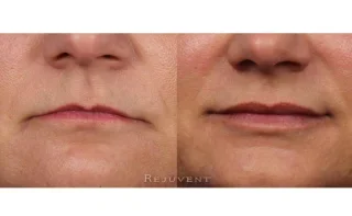 Volumized Lips with Restylane