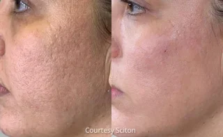 HALO acne scars results before and after