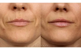 Lip enhancement and nasolabial folds