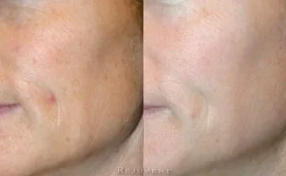 Brighter, more radiant, better texture after microdermabrasion and laser treatment