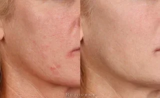 Beautiful and healthier skin after IPL, Peels and micro needling