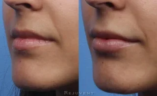 Side view Beautiful before and after lip injections
