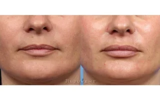 Lip Augmentation with lip fillers
