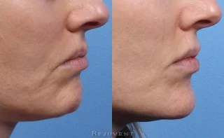 Chin augmentation with Restylane at Rejuvent in Scottsdale
