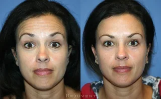 Botox Patient Forehead and Crows Feet Scottsdale