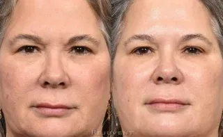 Moxi and BBL results on full face