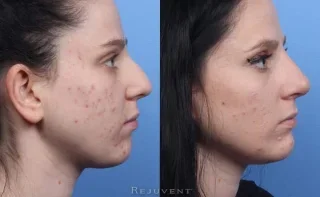 Non-surgical Rhinoplasty Beautiful results no surgery