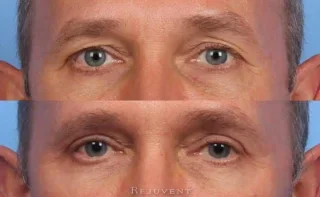 Male Patient Closeup Up Lower and Upper Eyelid surgery