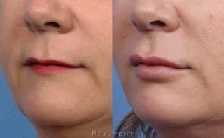 Fuller and more defined lip after lip fillers at Rejuvent