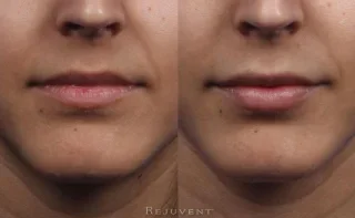 Front view beautiful Juvederm results