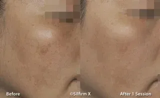 Sylfirm X before and after photo of skin pigmentation results