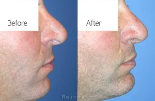 Nose surgery male patient