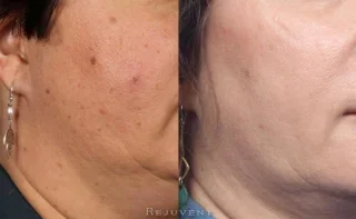 Aging skin rejuvenated after skin treatments