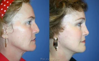 Rhinoplasty and facelift at Rejuvent Scottsdale side view