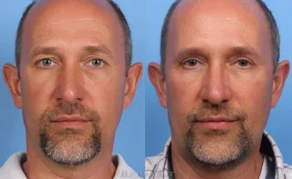 Lower and Upper Blepharoplasty Male Patient Before and After image