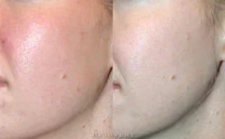 Large pores and skin redness correction - radiant skin