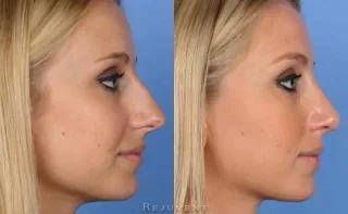 Side view of female patient after Rhinoplasty to remove hump