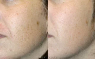 Aging Skin Great difference after treatment