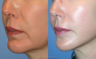 Chin and Facelift