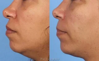 Improved Chin with Restylane Lyft