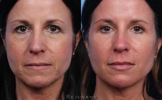 Beautiful Lower Face Rejuvenation with Fillers