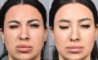 Daxxify injections glabella reesults