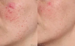 Rosacea And Redness Reduction