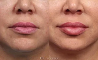 Plumper Lips and Better Asymmetry