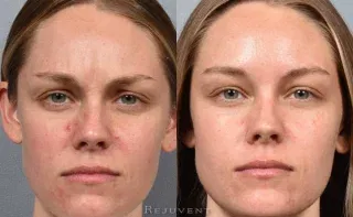Before and After Botox Glabella improvement