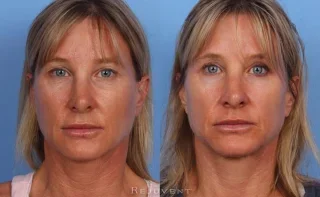 Lower and Upper eyelid surgery Female