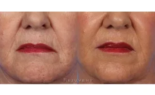 Liquid facelift and downturn mouth Botox 