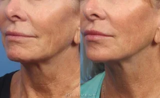 Lower face rejuvenation with dermal fillers