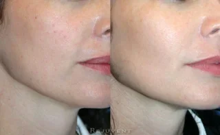 Redness and Texture improvement after skin treatment