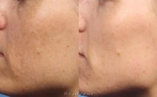 IPL clear skin results with less pigmentation
