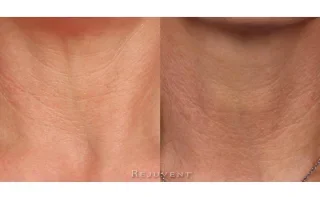 Neck Firming Photo 3 weeks use