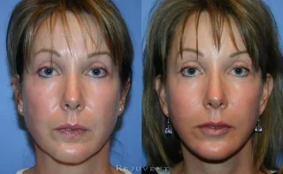 Patient Facelift before and after