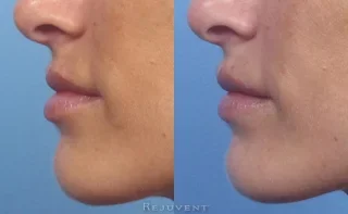 Lip filler correction - side view