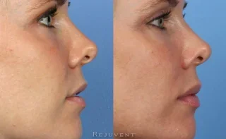 Lip Enhancement profile view