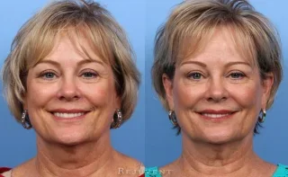 Botox in Aging Skin