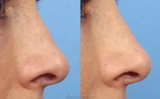 Great results on non-surgical nose enhancement with fillers