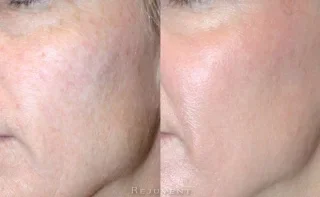 Amazing skin improvement after Levulan PDT at Rejuvent