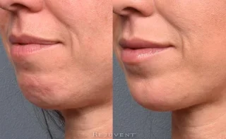 Profile View Chin Injections