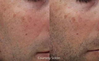 Moxi Laser before and After male results