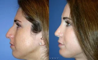Rhinoplasty - Nose surgery - Scottsdale