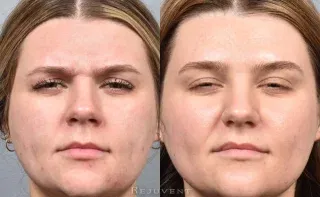 Glabella botox results show no wrinkles