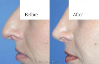 Nose surgery at Rejuvent