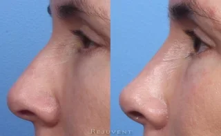 Non-surgical nose job with dermal fillers