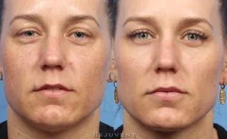 FotoFacial Clear Skin Results