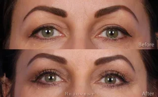Lower and Upper eyelid surgery at Rejuvent, Scottsdale.