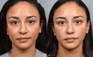 Filler Correction Before and After Results